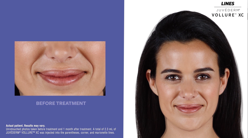 juvederm-vollure-xc