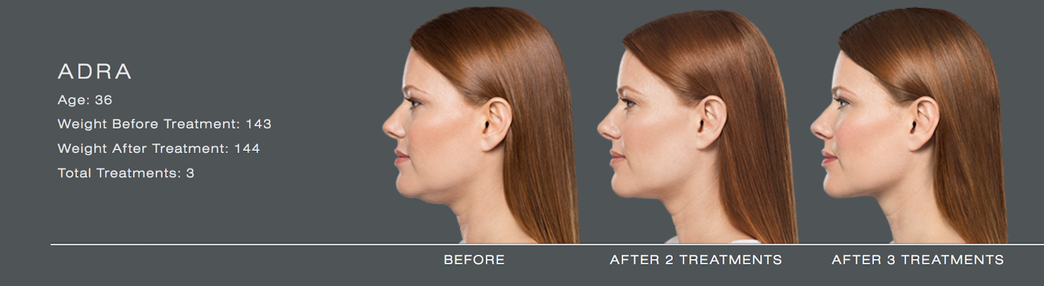 Kybella injectable