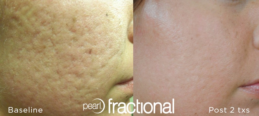Pearl Fractional Before and After Image